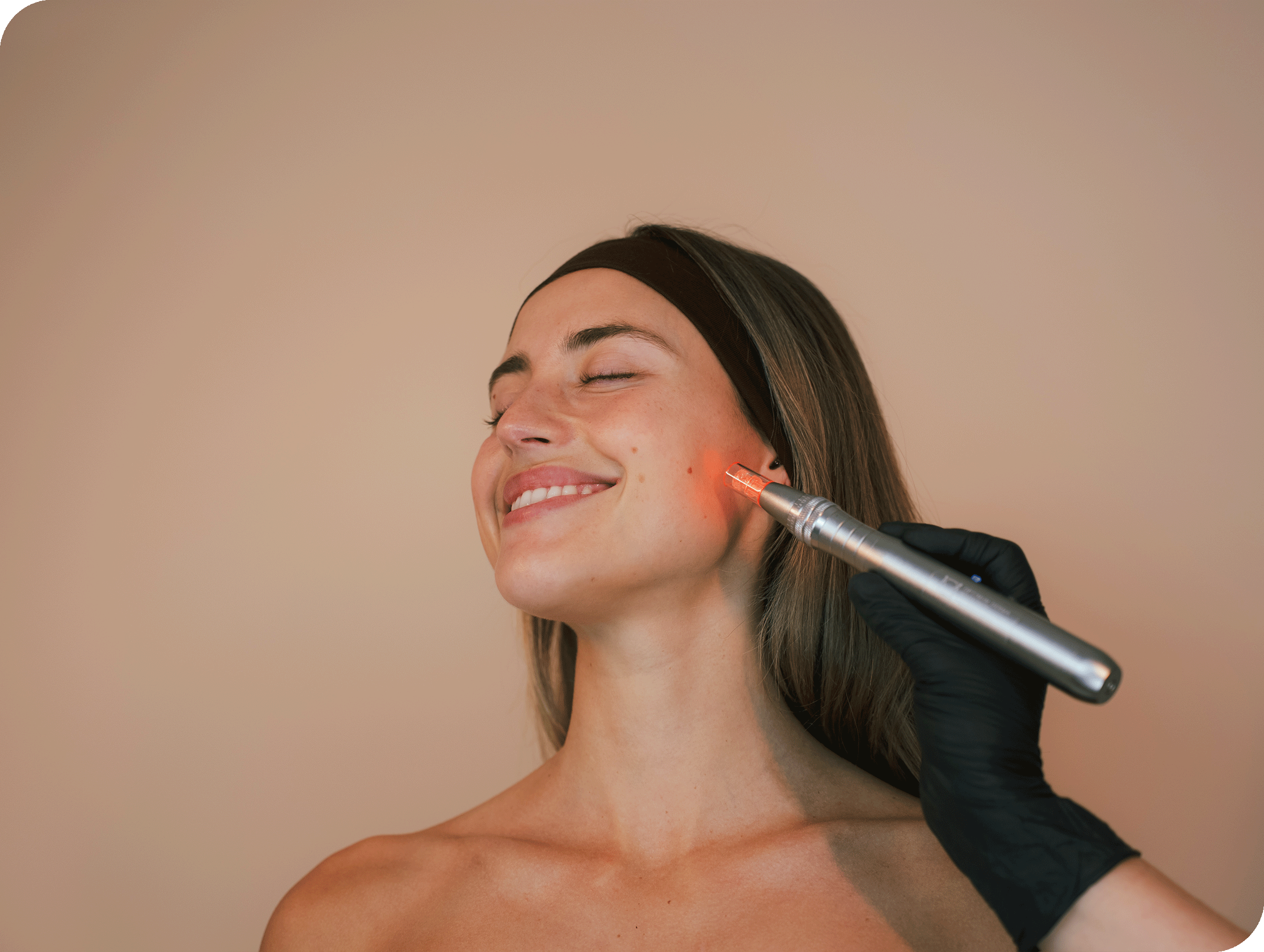 Microneedling
