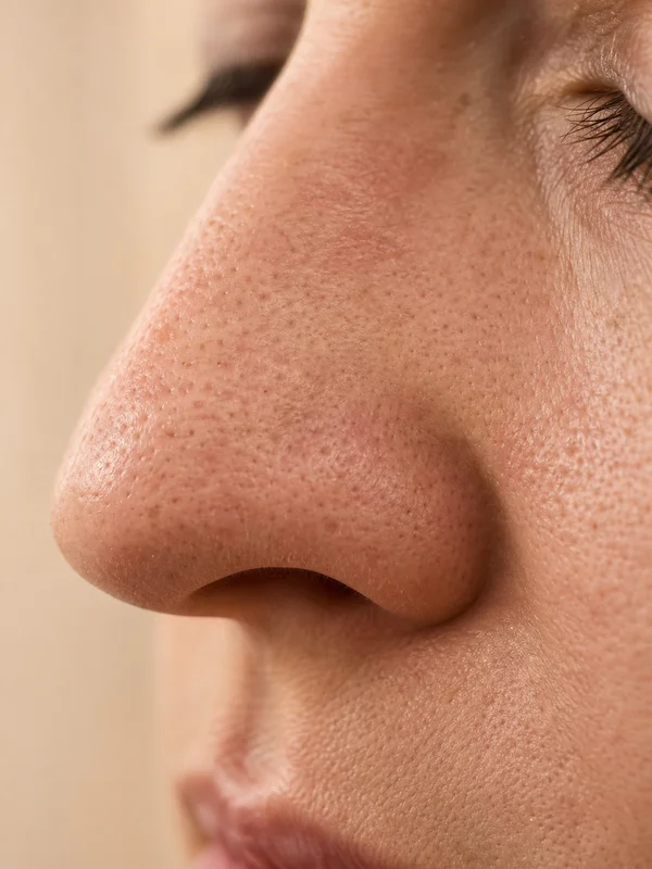 Enlarged Pores