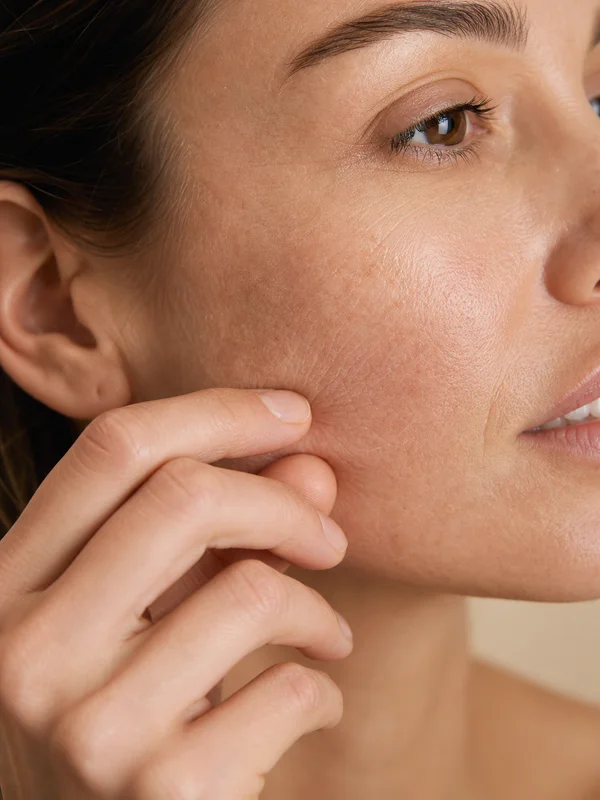 Dehydrated Skin