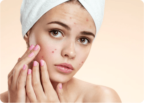 Tiener Acne