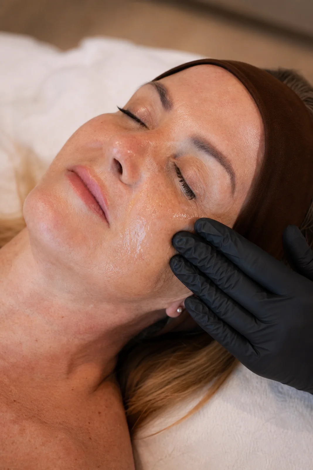 PRX-T33 Peeling — SKIN Amsterdam